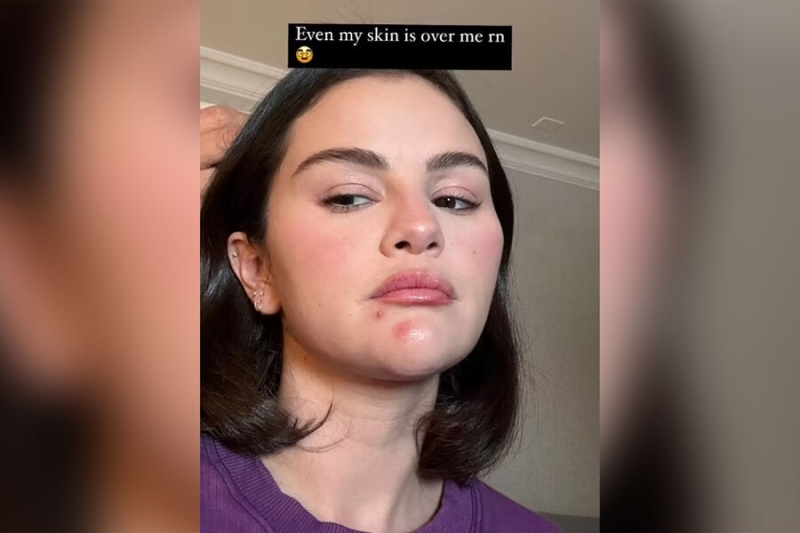 Певица Селена Гомес выложила фото с прыщами на лице